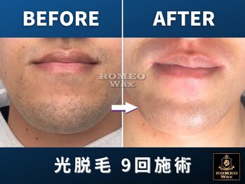 ロミオワックス ジュリエットワックス 新宿店(ROMEO Wax Juliet Wax)/ヒゲ脱毛で青髭感なし！！