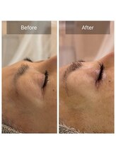 ルポアミ 代々木上原(REPOS AMI)/プラズマフェイシャル 3回の変化