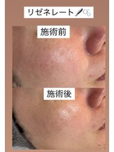 ハグ(hug)/大人気☆リゼネレート効果写真♪