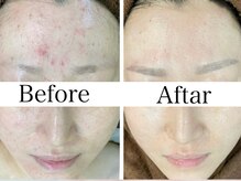 リラビューティー(Lilas Beauty)/ニキビケアもお任せ下さい