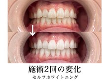 ビービーサロン 池袋(B.B salon)/セルフホワイトニング/歯を白く!
