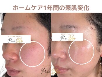 ポノ(Pono)/毛穴や赤み、諦めないで！