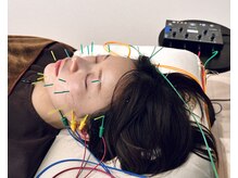 フラット(flat)/小顔美容鍼で即効リフトアップ