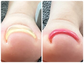 巻き爪/フットネイル/ワンカラー