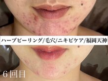 ホワイトアクア 福岡天神店(WHITE AQUA)/ハーブピーリングビフォー