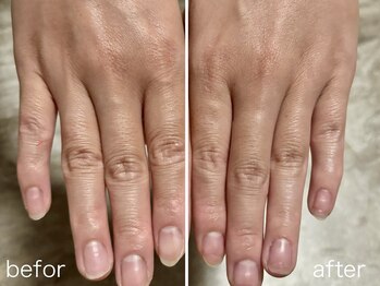 ミヤ(38)/指関節のシワ改善