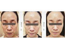 セラビシャン/before→after