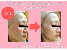 ソフィア ミューズ 目黒/目黒ピーリングで艶肌UP