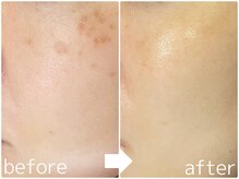 パールホワイトニングサロン 茅ヶ崎店/ハーブピーリング