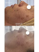 キュアリード(Cure_Lead)/高周波×空気圧×シミケア