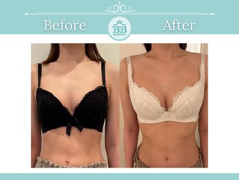 美人バスト 浜松店/◇ バストアップ &nbsp;BeforeAfter◇