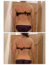 フラウラ(Fraula)/比較写真☆インディバ疲労回復