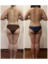 うつくし痩身 美サロン ゼットワン(Z-ONE)/筋膜リリースメディセル６回　