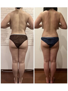 うつくし痩身 美サロン ゼットワン(Z-ONE)/筋膜リリースメディセル６回　