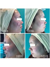 ヴィヴ 熊本(ViV)/肌質改善10回コース