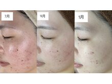 セン(Sen)の雰囲気（ニキビケア・毛穴ケアに特化したハーブピーリング施術）