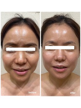 ブロッサム(Blossom)/摩擦レス美顔器この実力