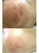 サロンドエステケイワイ(de KY)/フェイシャル☆濃いシミ改善