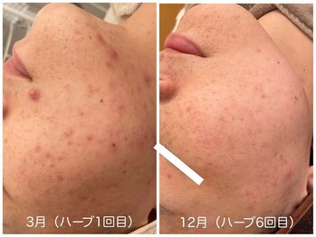 メゾンリュバン 天王寺(Maison Ruban)/ハーブピーリング・Elight