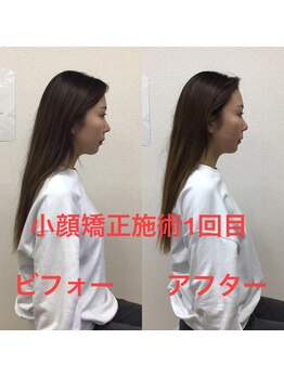 オズ六本木/六本木小顔矯正(造顔)姿勢整う