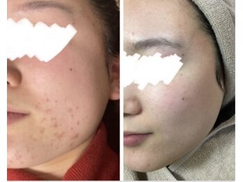 モッカ 北花田/ハイドラ×ハーブピーリング