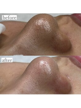 ライカブルー(RaicA BluE)/施術写真　before-after