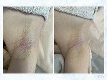 フルール(FLEUR)/ワキ脱毛