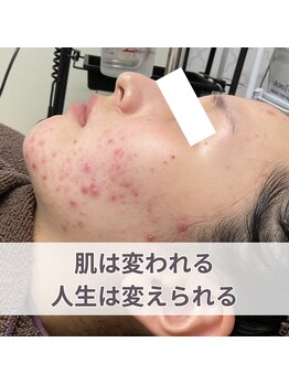 エステ ニキビケア研究所 川崎店/肌が変われる、人生は変えられる