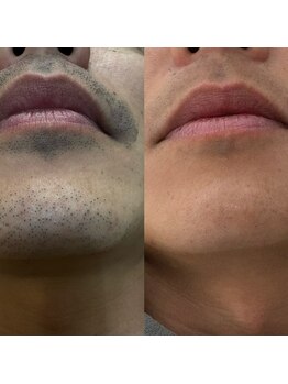 アルシスタ(ARCISTA)/【メンズ脱毛】ヒゲ脱毛９回目