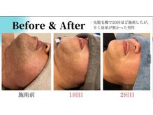 リア(Lia)/ひげ脱毛