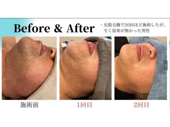 リア(Lia)/ひげ脱毛