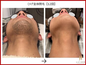 ひかり素肌/おひげ脱毛12回