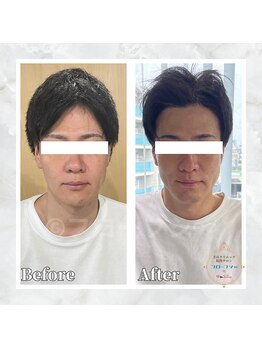 フローフシ∞/【小顔】30代男性症例写真
