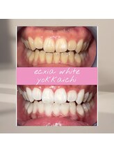 エクシアホワイトニング 四日市店/ホワイトニングビフォーアフター