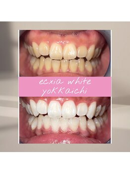 エクシアホワイトニング 四日市店/ホワイトニングビフォーアフター