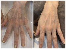 ミヤ(38)/手のくすみ改善