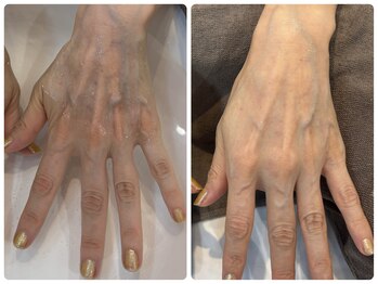 ミヤ(38)/手のくすみ改善