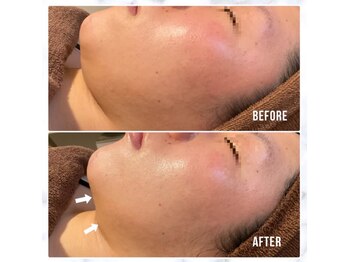 キセキ(KISEKI)/小顔フェイシャル