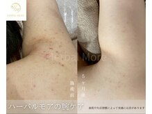 スキニティ 池袋(sknity)/【二の腕】ポツポツ抑え滑らかに
