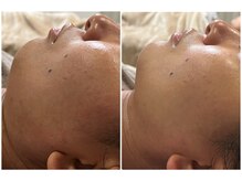 クランシュプール 恵比寿店/【リフトアップ/肌荒れ/幹細胞】