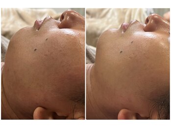 クランシュプール 恵比寿店/【リフトアップ/肌荒れ/幹細胞】