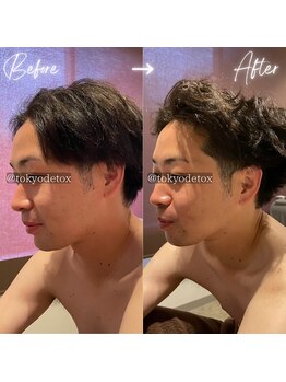 東京デトックス/小顔造形頭ほぐしFビフォアフ