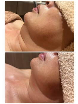 ラナ(LANA)/レモンボトル☆BeforeAfter