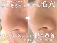 毛穴毛穴吸引毛穴洗浄ピーリングでハーブピーリングよりスッキリ