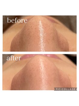 ランソ ビューティー 成田(RUNSO Beauty)/ハイドラ毛穴洗浄