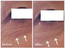 ルー ハナレ 神戸岡本 摂津本山店(Luu HANARE)/目元たるみ　しわ　クマ改善