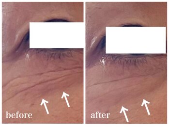 ルー ハナレ 神戸岡本 摂津本山店(Luu HANARE)/目元たるみ　しわ　クマ改善