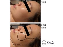 フィーラ(Feela)/マイクロニードルピーリング