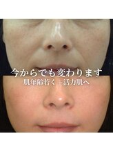 サロン ド ボーテ シャルル(Chaleureux)/エイジング肌改善は