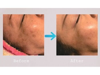 リュウ鍼灸院 サロン ド リュウ(Salon de Ryu)/マイクロラボピーリング